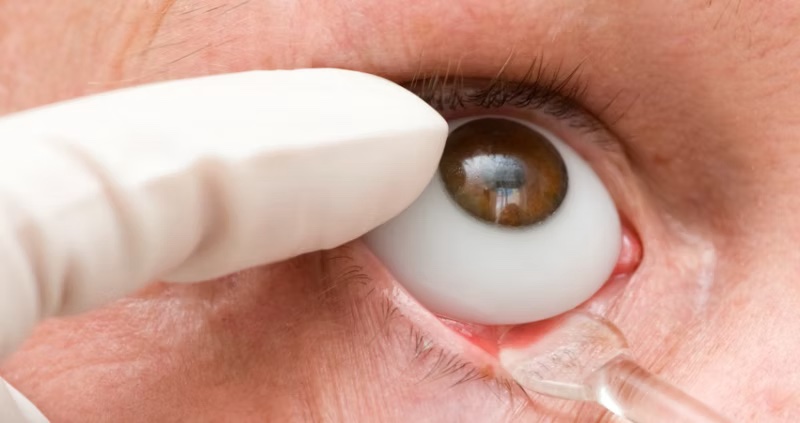 Prothèse Oculaire